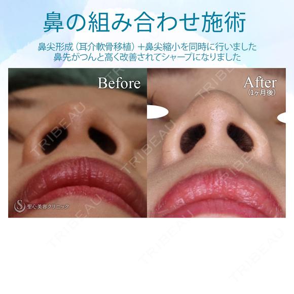【20代女性・鼻先をスッキリ】鼻尖縮小＋耳介軟骨移植（1ヵ月後） after画像 メイン用