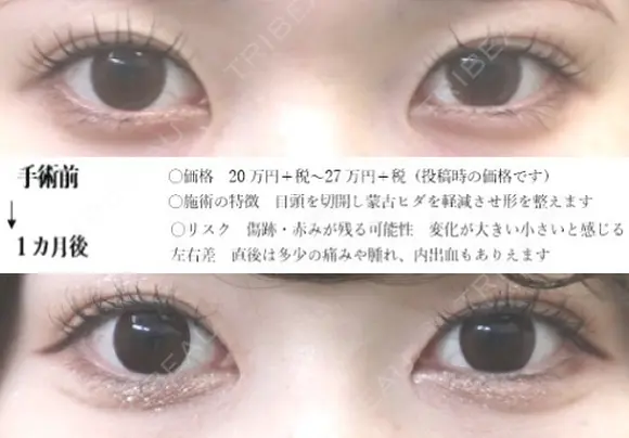 目頭切開 before画像 メイン用