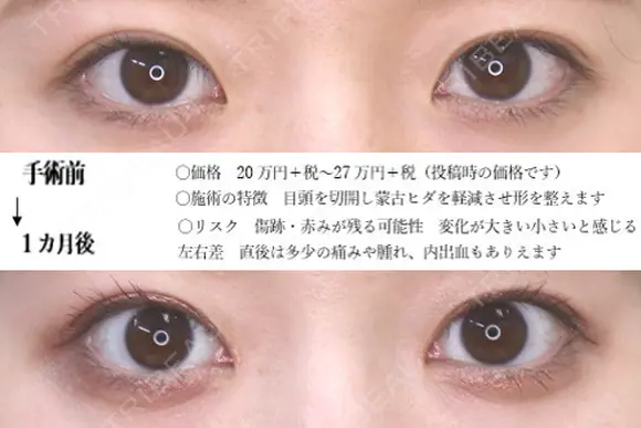 目頭切開 31日後 メイン用