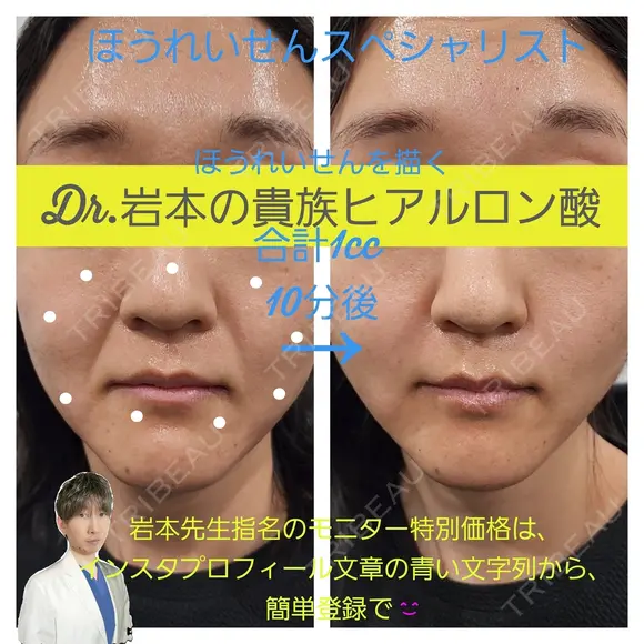 貴族ヒアルロン酸 before画像 メイン用
