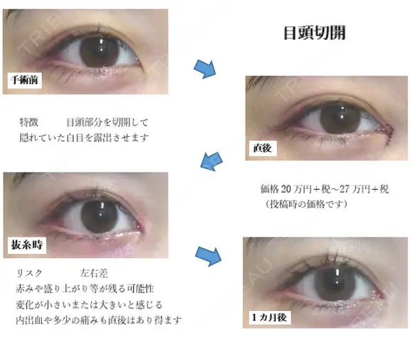 目頭切開 31日後 メイン用