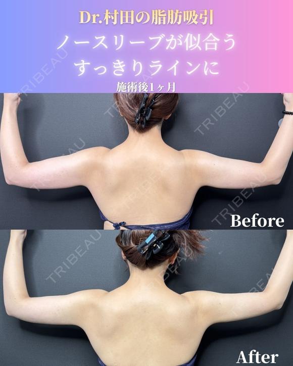 二の腕＋肩＋脇肉　脂肪吸引 30日後 メイン用