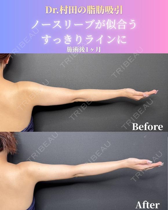 二の腕＋肩＋脇肉　脂肪吸引 30日後 メイン用