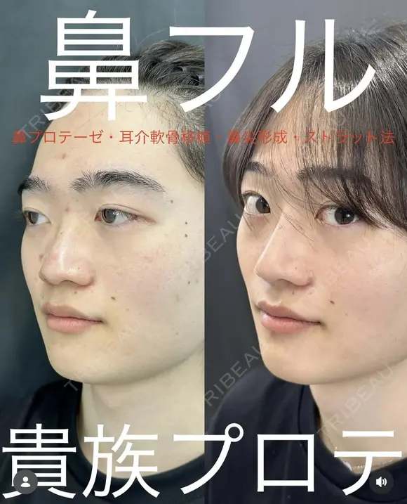 鼻フル　貴族プロテーゼ before画像 メイン用