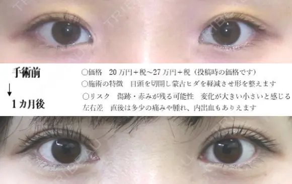 目頭切開 before画像 メイン用
