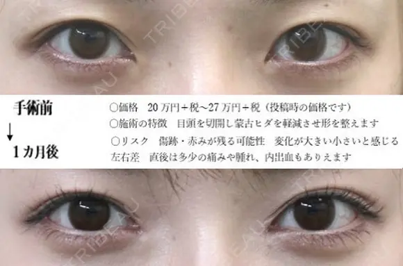 目頭切開 31日後 メイン用