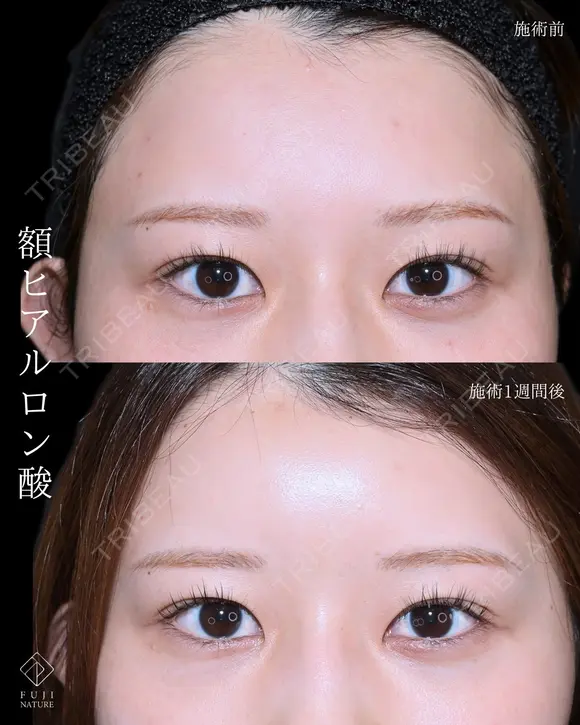 額　ヒアルロン酸注入 before画像 メイン用
