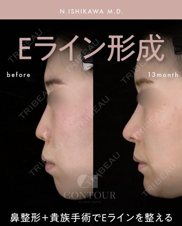忘れ鼻整形 before画像 メイン用