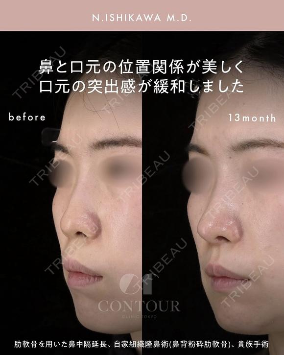 忘れ鼻整形 390日後 メイン用