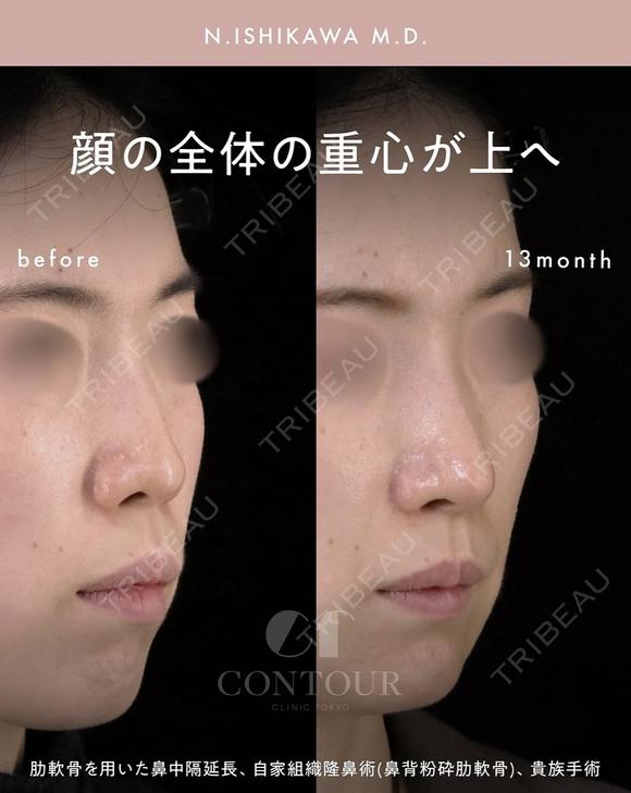 忘れ鼻整形 390日後 メイン用