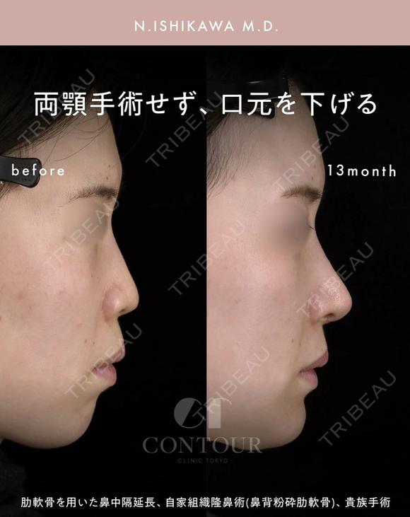 忘れ鼻整形 390日後 メイン用