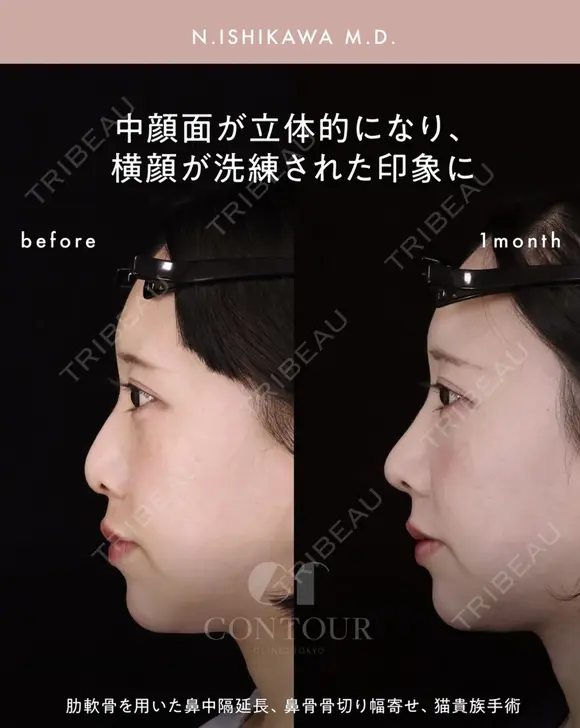 忘れ鼻整形 30日後 メイン用