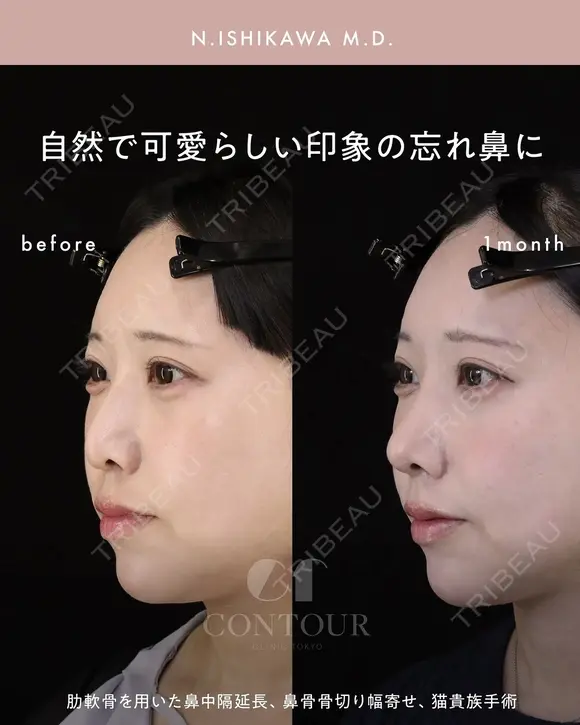 忘れ鼻整形 30日後 メイン用
