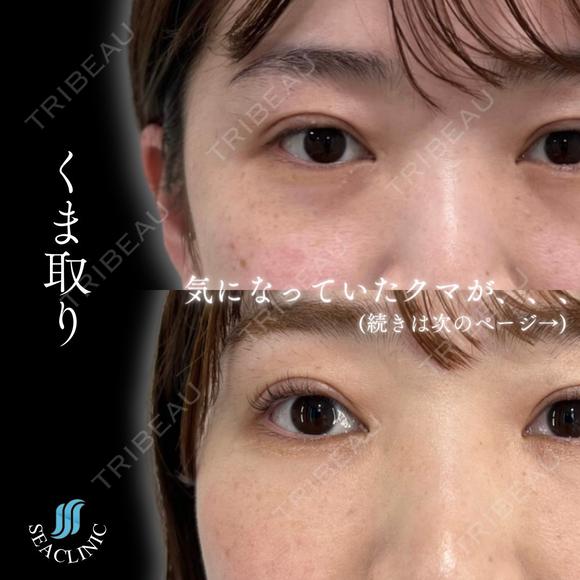 クマ取り before画像 メイン用