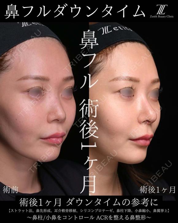 鼻フルダウンタイム 30日後 メイン用