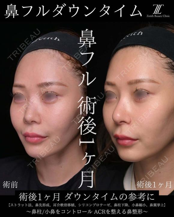 鼻フルダウンタイム before画像 メイン用