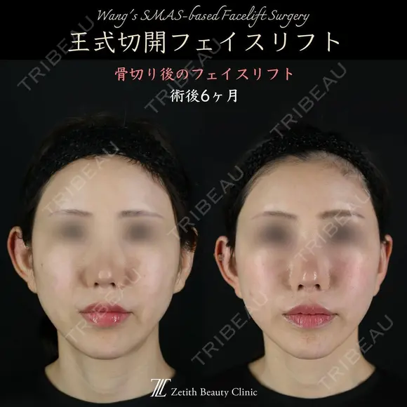 王式切開フェイスリフト 180日後 メイン用