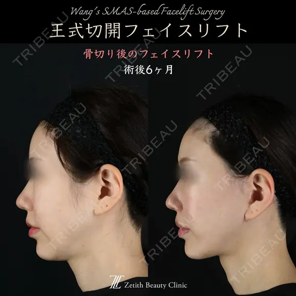 王式切開フェイスリフト 180日後 メイン用