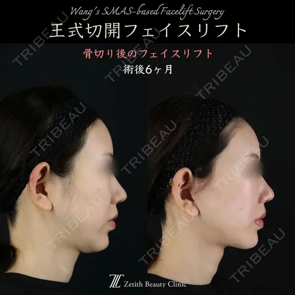 王式切開フェイスリフト 180日後 メイン用