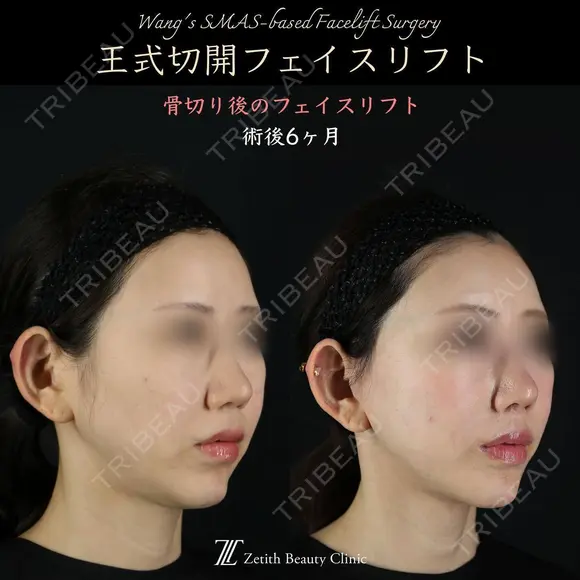 王式切開フェイスリフト 180日後 メイン用