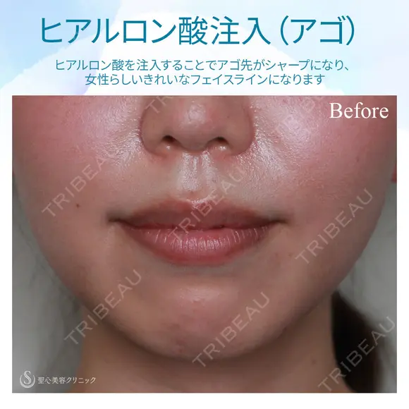 【20代女性・顎ヒアルロン酸注入】ジュビダームビスタ ボラックス before画像 メイン用