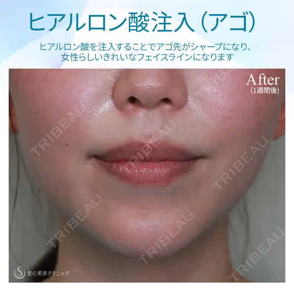 【20代女性・顎ヒアルロン酸注入】ジュビダームビスタ ボラックス 7日後 メイン用