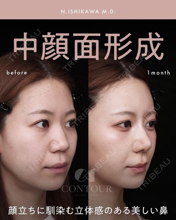 忘れ鼻整形 before画像 メイン用