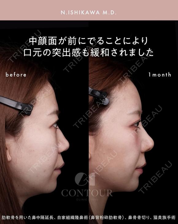 忘れ鼻整形 30日後 メイン用