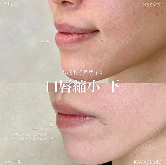 加賀デザイン×口唇縮小下 before画像 メイン用