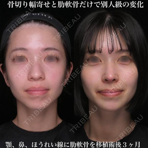 肋軟骨による鼻中隔延長 before画像 メイン用