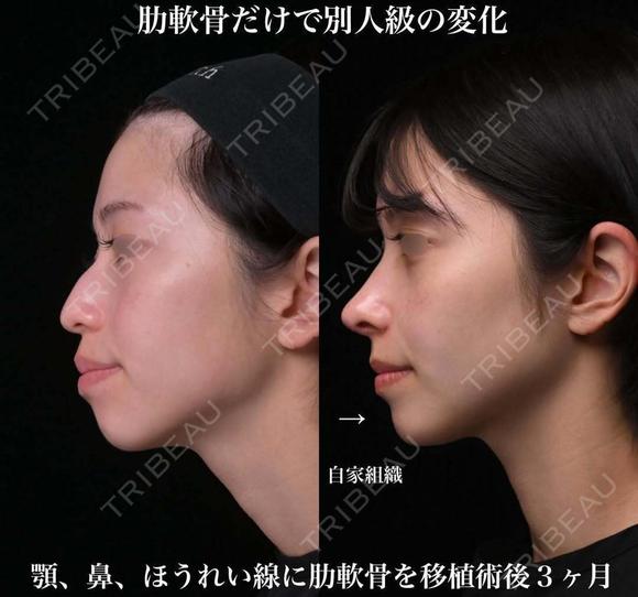 肋軟骨による鼻中隔延長 90日後 メイン用