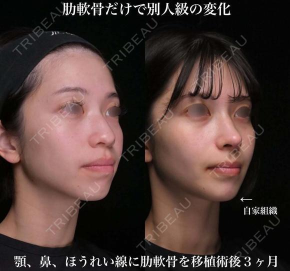 肋軟骨による鼻中隔延長 90日後 メイン用