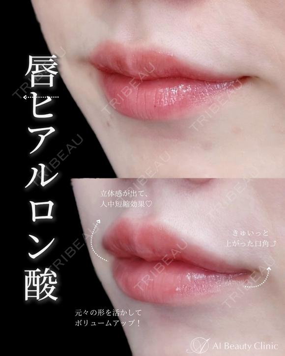 唇ヒアルロン酸 after画像 メイン用