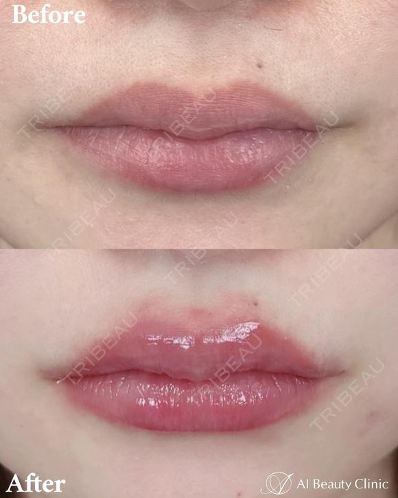 唇ヒアルロン酸 before画像 メイン用