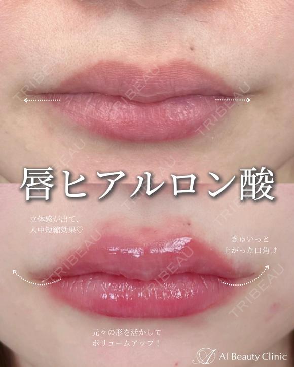 唇ヒアルロン酸 after画像 メイン用