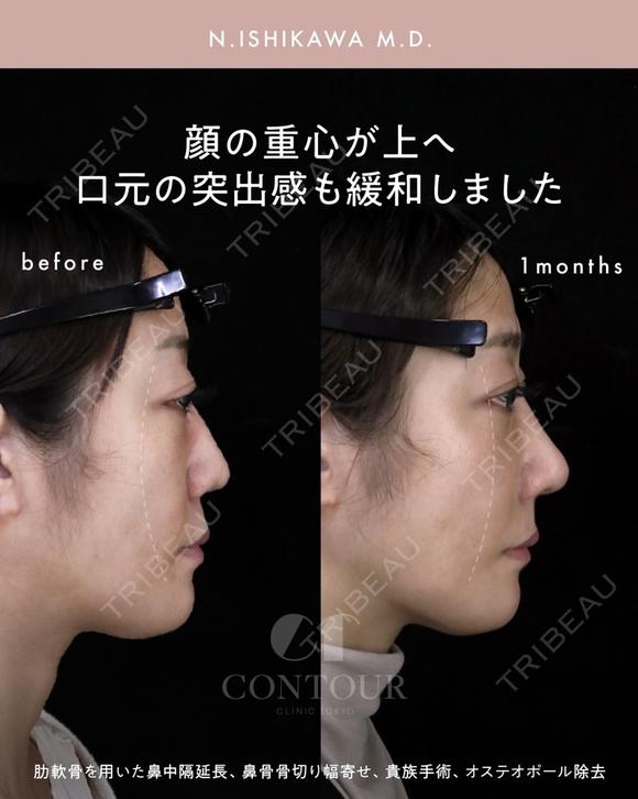 忘れ鼻整形 30日後 メイン用