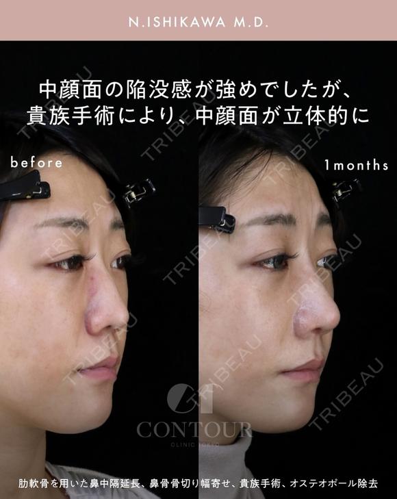 忘れ鼻整形 30日後 メイン用