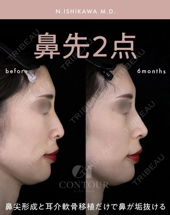 忘れ鼻整形 180日後 メイン用