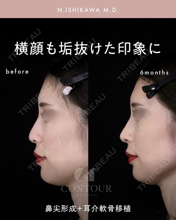 忘れ鼻整形 180日後 メイン用