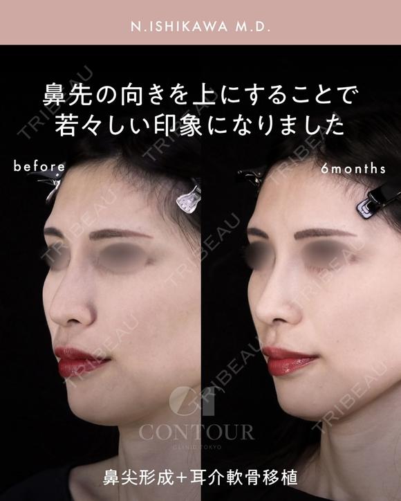 忘れ鼻整形 180日後 メイン用