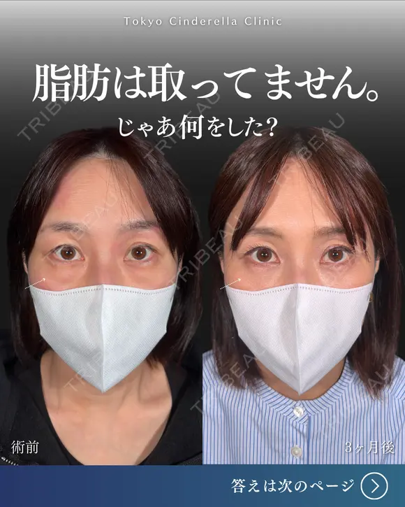 MD式裏ハムラ法 90日後 メイン用