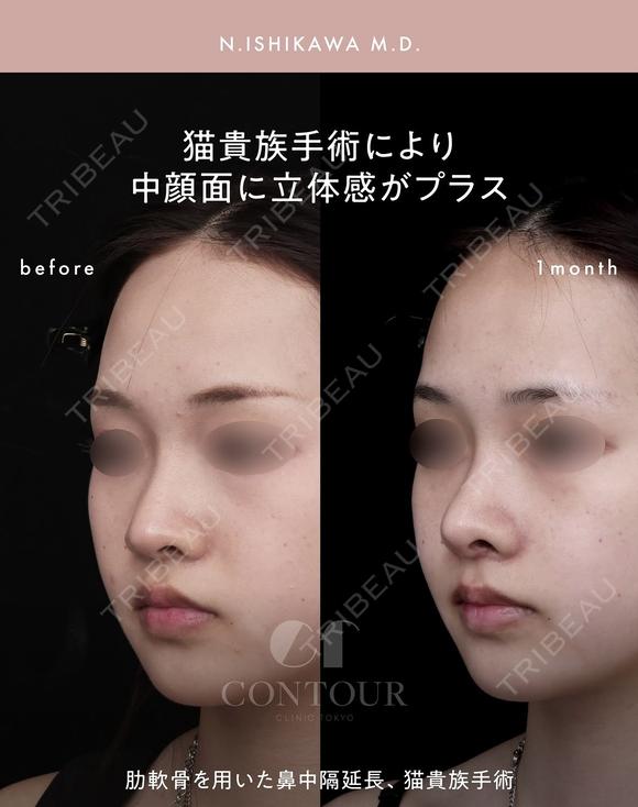 忘れ鼻整形 30日後 メイン用