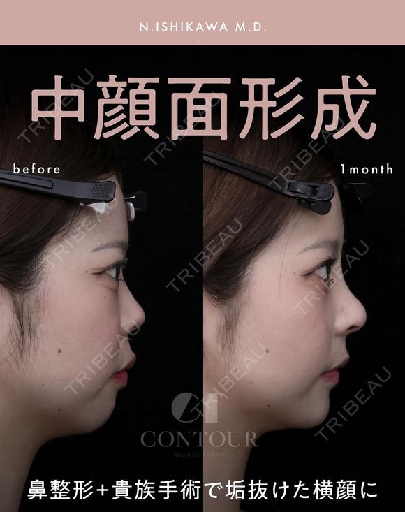 忘れ鼻整形 before画像 メイン用