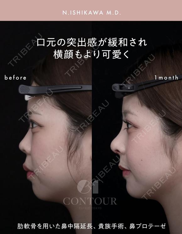 忘れ鼻整形 30日後 メイン用