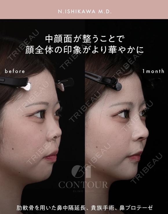 忘れ鼻整形 30日後 メイン用