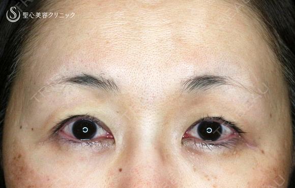 【50代女性・ハードコンタクトレンズ眼瞼下垂】切らない眼瞼下垂+α法（術直後） 0日後 メイン用