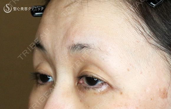 【50代女性・ハードコンタクトレンズ眼瞼下垂】切らない眼瞼下垂+α法（術直後） before画像 メイン用