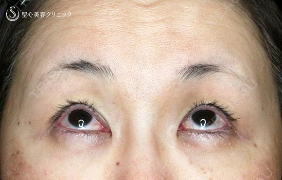 【50代女性・ハードコンタクトレンズ眼瞼下垂】切らない眼瞼下垂+α法（術直後） 0日後 メイン用