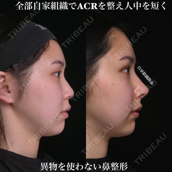 全部自家組織でACRを整え人中を短く 90日後 メイン用