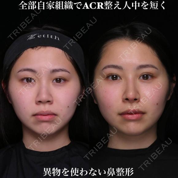 全部自家組織でACRを整え人中を短く before画像 メイン用